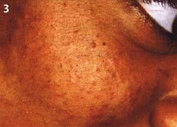 Gesicht eines männlichen Patienten mit dunkler Hautfarbe