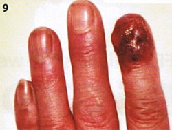 Vier Finger der linken Hand. Am Zeigefinger ist statt eines Fingernagels eine rotbraune Wucherung zu sehen, die bis zum obersten Gelenk des Fingers hinabreicht