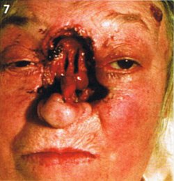 Patientin, der vom Krebs ein Teil des Gesichtes (Nase und Wange) 'weggefressen' wurde, so dass man die Gesichtsknochen und den Eingang zu den Nasennebenhöhlen sehen kann