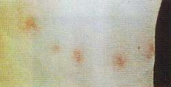 Mehrere aufeinanderfolgende rote Punkte auf der Haut eines Patienten