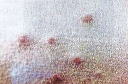 Mehrere rote Punkte auf der Haut eines Patienten - keine besondere Anordnung erkennbar
