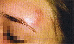 Rötung über dem rechten Auge einer jungen Frau